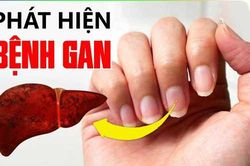 Điểm 'lạ' trên cơ thể cảnh báo gan đang dần 'nhàu nát' mỗi ngày, hãy nhanh chân đi gặp bác sĩ