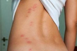 Bọ ve cắn: Nguyên nhân, điều trị và phòng tránh