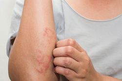 Căn bệnh về da khiến phụ nữ rơi vào khủng hoảng tinh thần trầm trọng