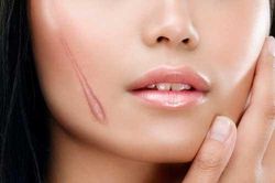 Da trắng không tỳ vết, sẹo lồi lõm được 'là phẳng' hoàn toàn chỉ với cách làm cực rẻ tiền này