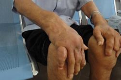 Nguy hiểm khôn lường khi tự ý điều trị bệnh gút tại nhà