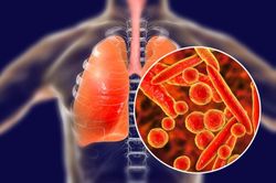 Lao phổi: phải tuân thủ điều trị mới khỏi bệnh