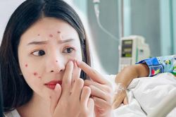 Viêm nội sọ chỉ vì nặn mụn: Những vùng mụn nguy hiểm chị em cần biết