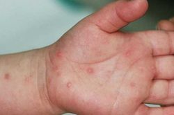 Phát hiện 26 ổ dịch tay chân miệng ở Đông Anh - Hà Nội