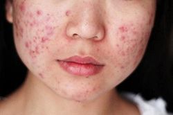 Thêm một thuốc mới trị mụn trứng cá