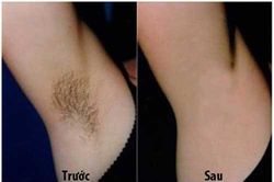 Tuyệt chiêu khiến lông nách biến mất vĩnh viễn trong 2 phút không cần nhíp