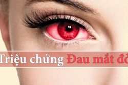 Khó chịu với đau mắt đỏ