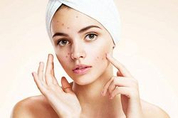 Bỏ ngay những thói quen dưới đây nếu không muốn mụn đeo bám dai dẳng