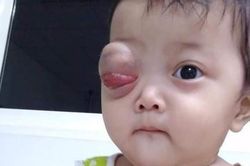 Xin giúp cháu bé 10 tháng tuổi con nhà nghèo, bị u ác tính