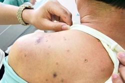 Người đàn ông tiểu ra máu sau khi bị ong đốt