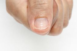Những biến đổi trên tay, chân cảnh báo bệnh ung thư gan