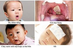 Dấu hiệu nhận biết và cách phòng bệnh bạch hầu hiệu quả nhất