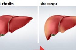 Bé trai mới 8 tuổi đã phát hiện bị gan nhiễm mỡ