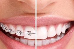 Chỉnh nha có khiến răng bị lung lay?
