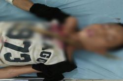 Sơn La: Bé trai 12 tuổi bị cành cây đâm xuyên cổ