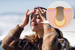 7 sai lầm chăm sóc da khiến mặt ngày càng nổi nhiều mụn