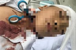 Bác sĩ chạy đua cứu bé trai bị kéo đâm xuyên cổ