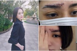 Chung Hân Đồng lần đầu đăng ảnh sau khi bị thương nặng, nhiều người không thương mà còn mắng chửi