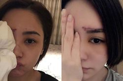 Chung Hân Đồng phải khâu hơn 60 mũi