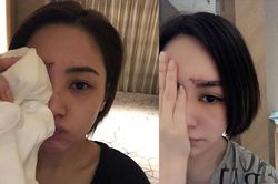 Chung Hân Đồng chia sẻ ảnh những vết sẹo sau 3 lần phẫu thuật, khâu hơn 60 mũi