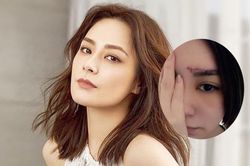 Ngã trong nhà vệ sinh, Chung Hân Đồng phải khâu hơn 60 mũi
