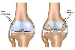 Canakinumab có thể làm chậm quá trình thoái hóa khớp?