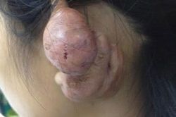 Bấm lỗ tai và hàng loạt biến chứng đáng sợ khiến ai cũng rùng mình