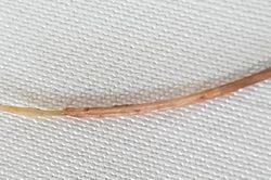 Xương cá dài 3cm đâm thủng ruột người