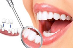 Những biến chứng đáng sợ của việc bọc răng thẩm mỹ