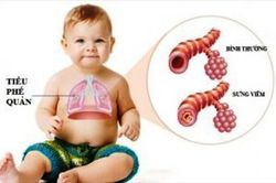 Biến chứng do viêm tiểu phế quản