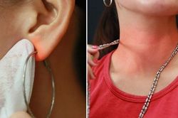 Vì sao bị dị ứng da do đeo trang sức kim loại?