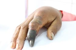 Anh tiều phu bị rắn hổ mang chúa dài 2,4m cắn, phải tháo khớp ngón tay