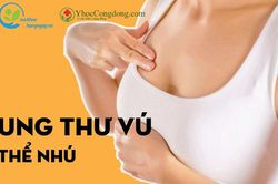 Tất tần tật những điều bạn cần biết về ung thư vú thể nhú