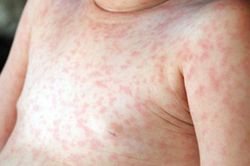 Sốt xuất huyết và sốt phát ban: Triệu chứng tương đồng dễ gây nhầm lẫn
