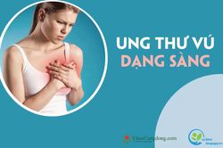 Ung thư vú dạng sàng: Mọi điều bạn cần biết
