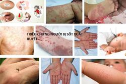 6 biểu hiện sốt xuất huyết điển hình và cách phân biệt chi tiết