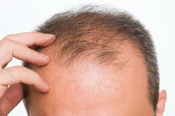 7 thực phẩm giúp giảm rụng tóc