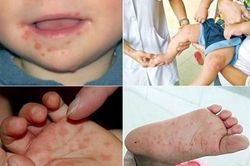 Bệnh tay chân miệng gia tăng nhanh tại TPHCM