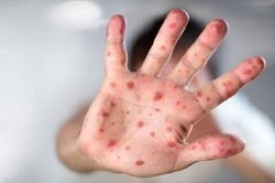 640 ca mắc tay chân miệng trong 1 tuần ở TP HCM