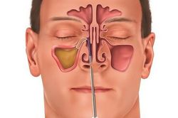 Phù nề niêm mạc mũi do viêm xoang và những điều cần biết