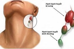 Nguyên nhân khiến cơ thể nổi hạch