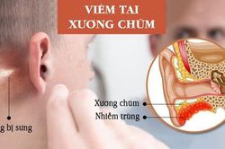 Cảnh giác với viêm tai xương chũm