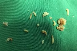 Bác sĩ lấy ra gần 20 chiếc răng trong khối u