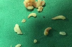 Lấy gần 20 chiếc răng cho bé 12 tuổi bị khối u răng hiếm gặp