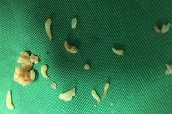 Lấy gần 20 chiếc răng trong khối u của bệnh nhi 12 tuổi