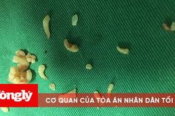 Lấy gần 20 chiếc răng trong khối u răng hiếm gặp