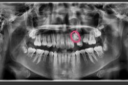 Bé 12 tuổi bị u răng: Triệu chứng, điều trị, dinh dưỡng phù hợp?