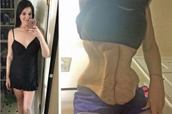 Vùng bụng nhăn nhúm của cô gái giảm 105kg trong 1 tháng khiến dân mạng khiếp sợ