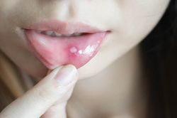 Những điều chưa biết về nhiệt miệng