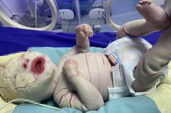 Bé sinh non bị lớp sừng trắng bao phủ toàn thân